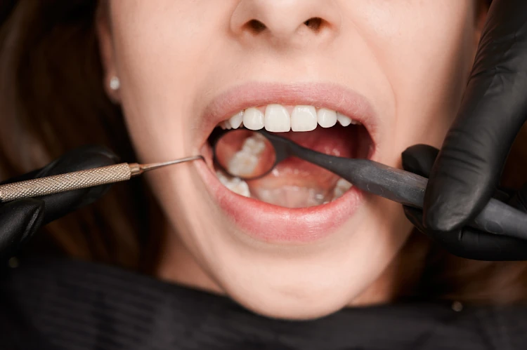 Read more about the article Dental Crowns vs. Veneers: Understanding the Differences in Paddington